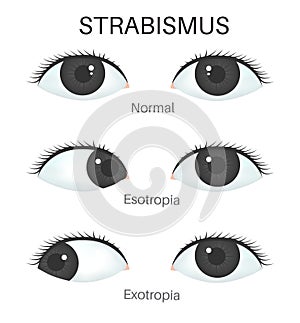 Types ofÃÂ strabismus. Esotrobia and Exotrobia photo